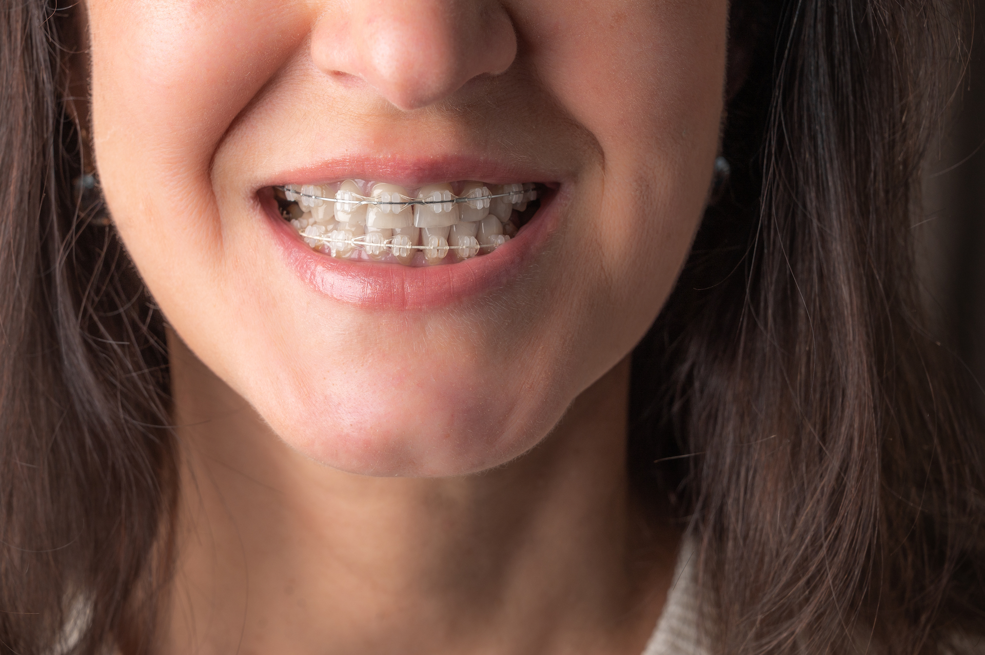 Woman looks teeth with braces. Dental care photo with orthodontic accessories. Close up